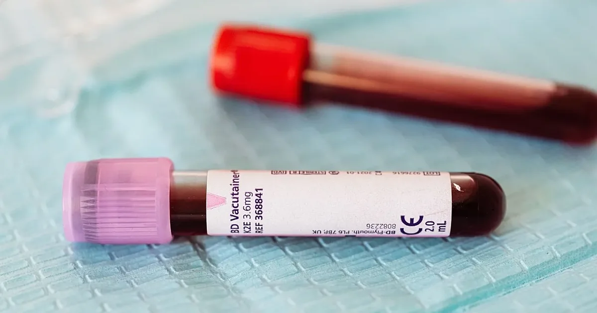 Etiopia konfirmon vdekjen e 3 personave nga virusi Marburg  alarm rajonal