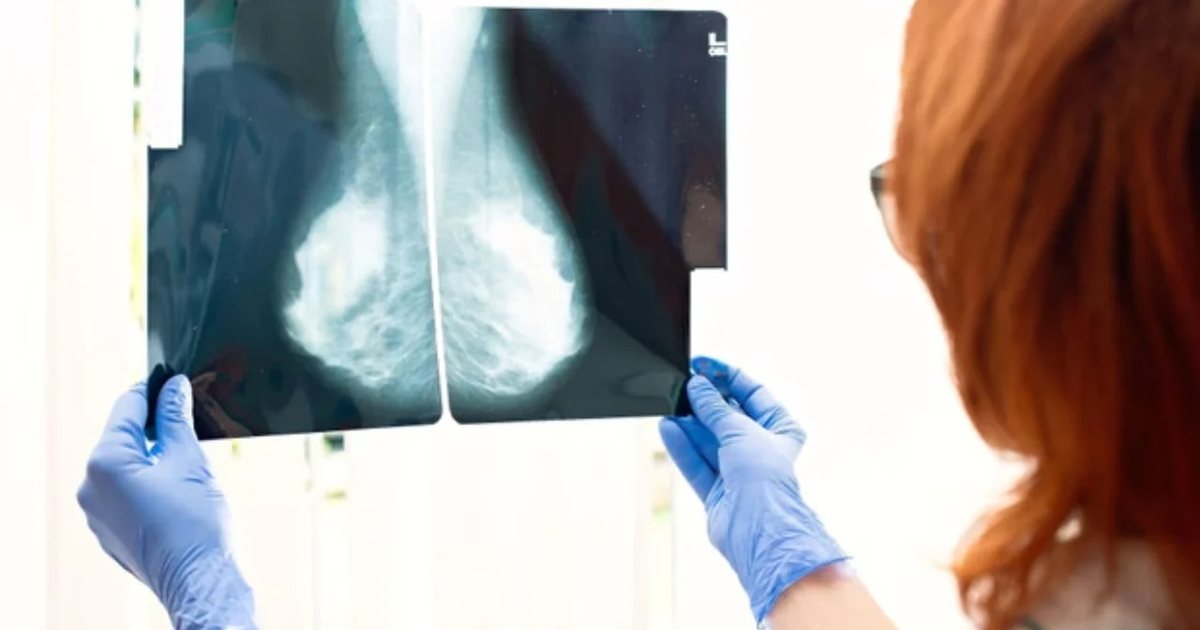 Revolucion në trajtimin e kancerit të gjirit  testi i ri përcakton se cila është terapia më efektive për pacienten