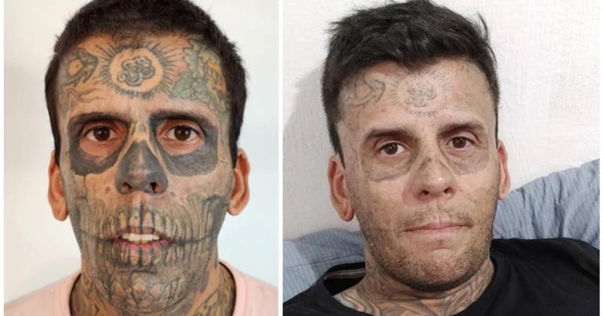  Kisha 95  të trupit me tatuazhe dhe dukesha si majmun cirku fillova t i heq  por është më e dhimbshme se kur i bëra