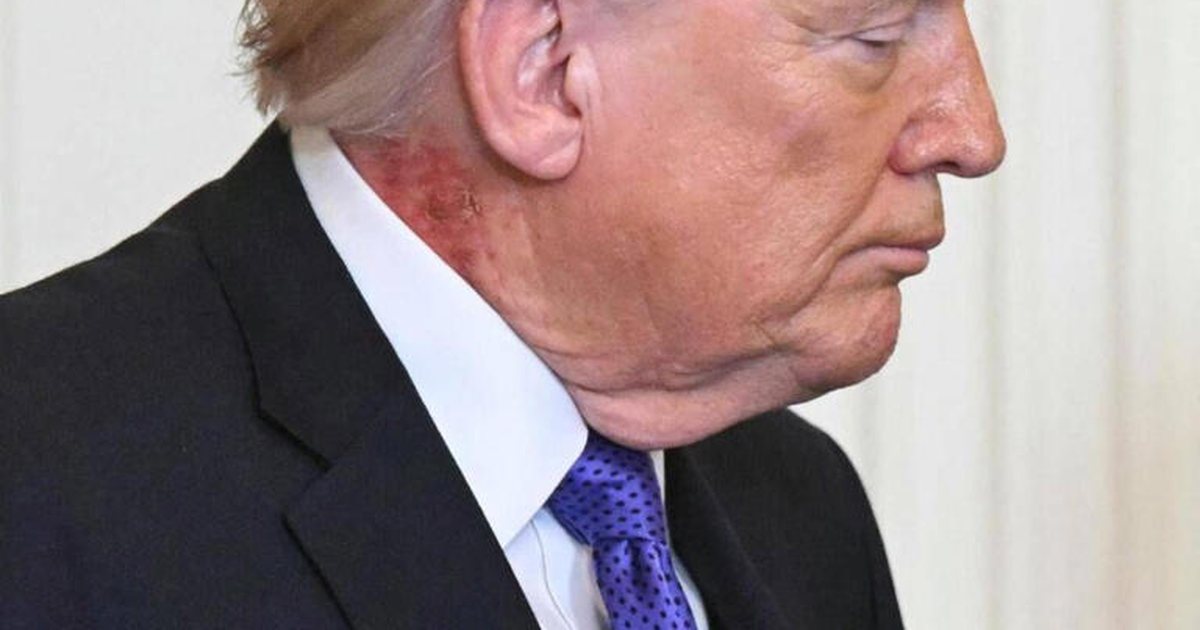 Trump dhe qafa e tij e kuqe  fotografia ngjall përsëri dyshime rreth shëndetit të presidentit