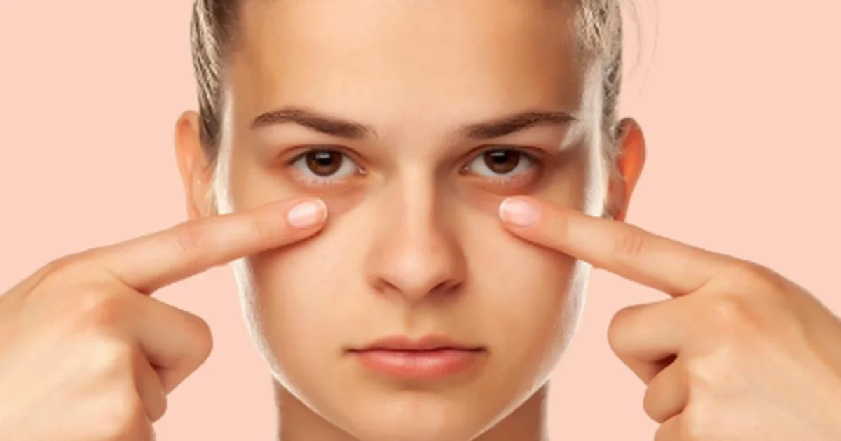 Rrathët nën sy  Si t i parandaloni dhe largoni nga fytyra juaj njëherë e përgjithmonë