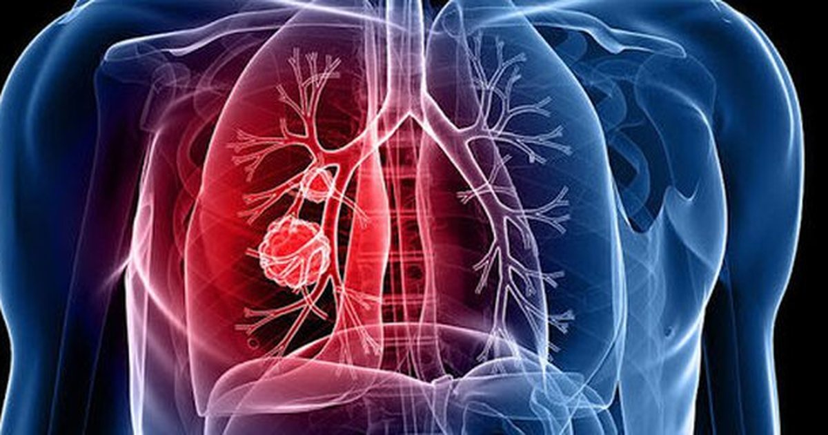 Raporti i OBSH  Tuberkulozi  kërcënim serioz në Europë  1 në 5 raste nuk raportohet