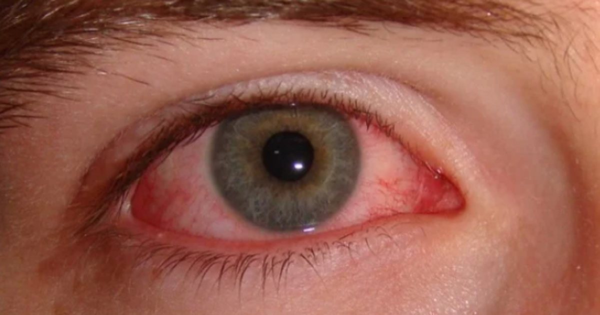 Sytë e skuqur pas zgjimit  Ja se kur është normale dhe kur duhet shqetësuar 