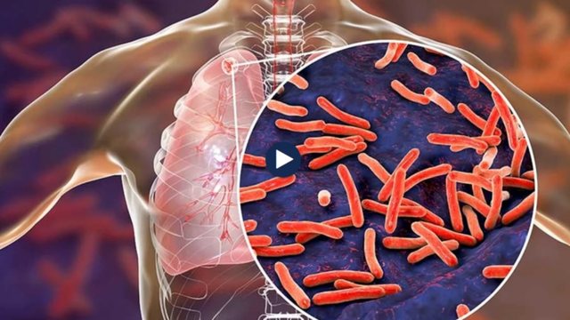 Mjekët ngrenë alarmin! Rishfaqet tuberkulozi, mbi 200 raste në
