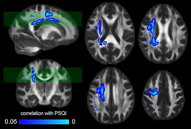 Ja se si mungesa e gjumit d&euml;mton neuronet e trurit ton&euml;, sipas