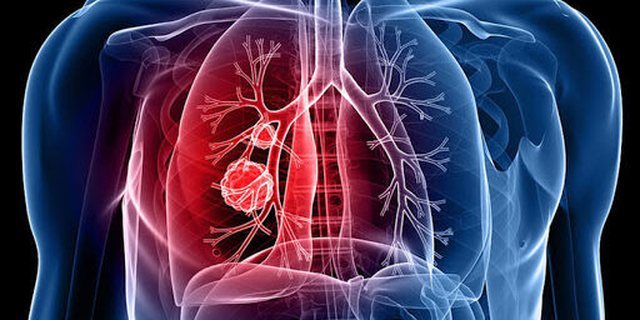 Raporti i OBSH: Tuberkulozi, k&euml;rc&euml;nim serioz n&euml; Europ&euml;, 1