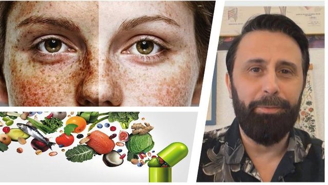 Nutricionisti Altin Joka: Njolla kafe në fytyrë? Nuk është